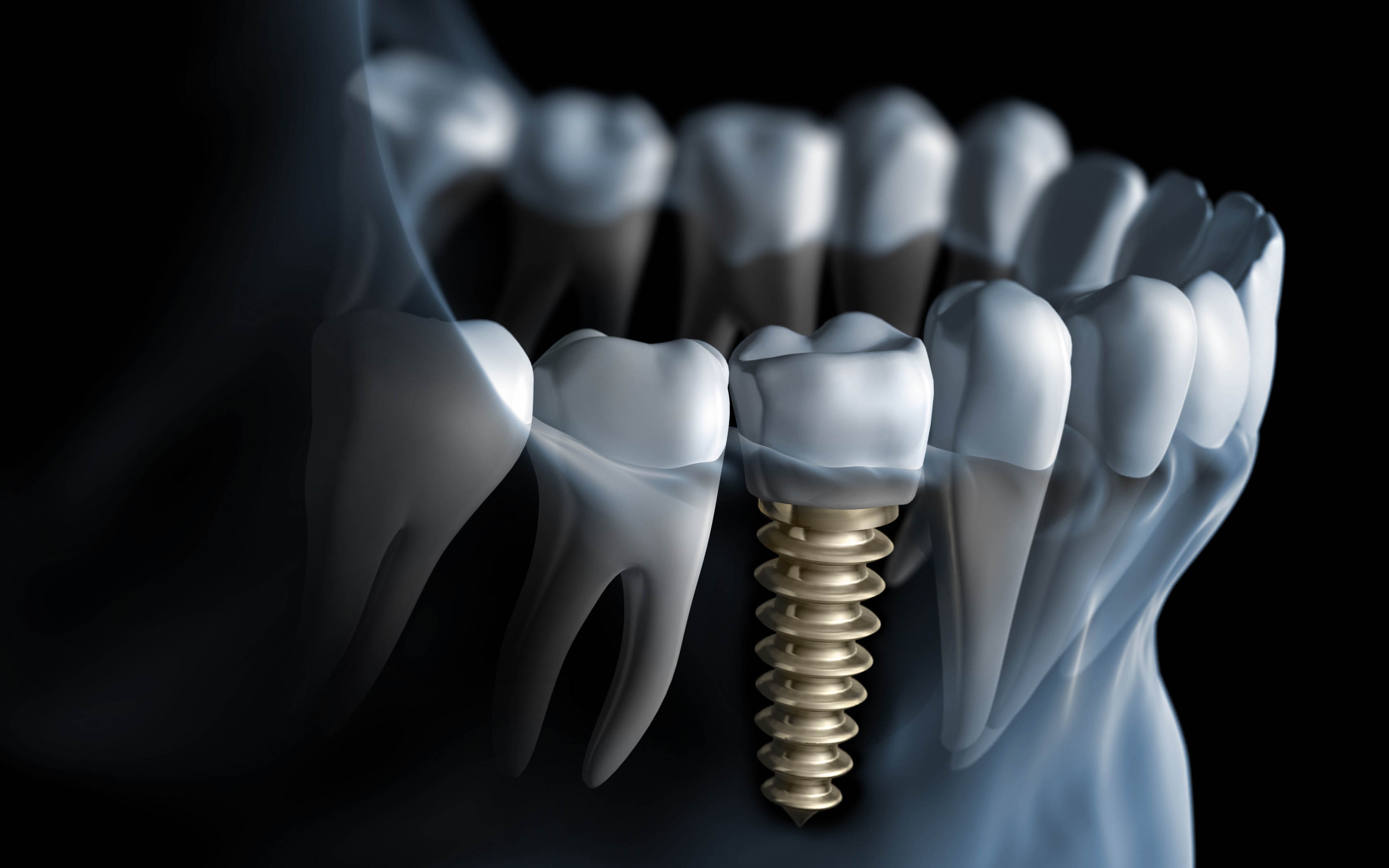 18-6-13-214234dental-implants